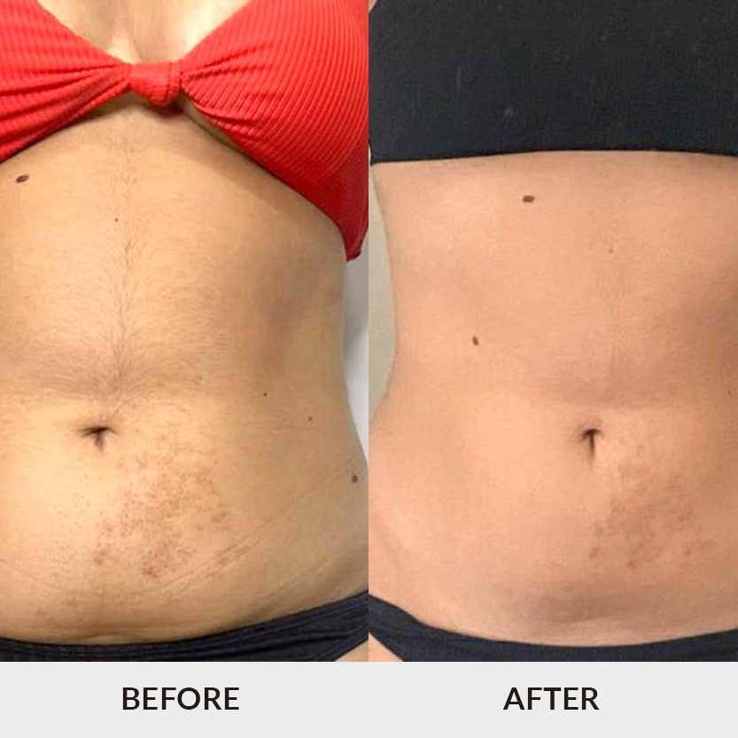 1 Sculpting & Fat Freezing Perth - Unique Beauty & Style