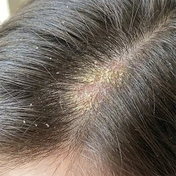 Advanced scalp analysis and hair loss treatment by a Trichologist in Perth.