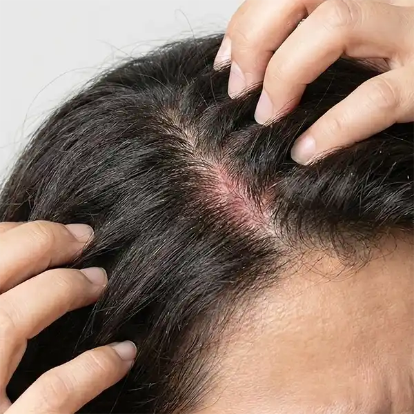 Advanced scalp analysis and hair loss treatment by a Trichologist in Perth.