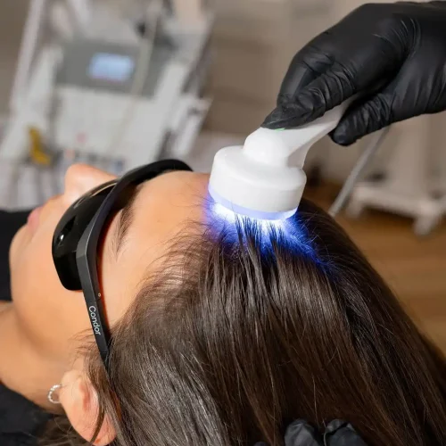 Advanced scalp analysis and hair loss treatment by a Trichologist in Perth.